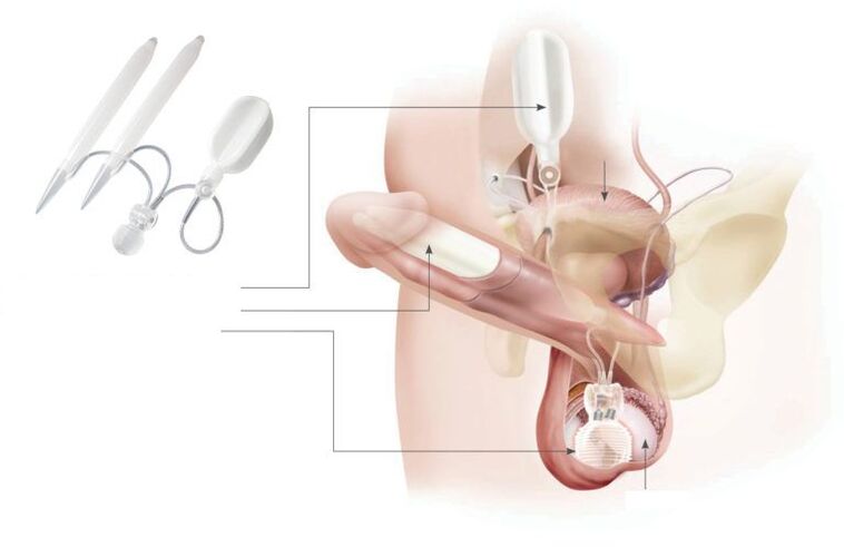 gel implantati u penis